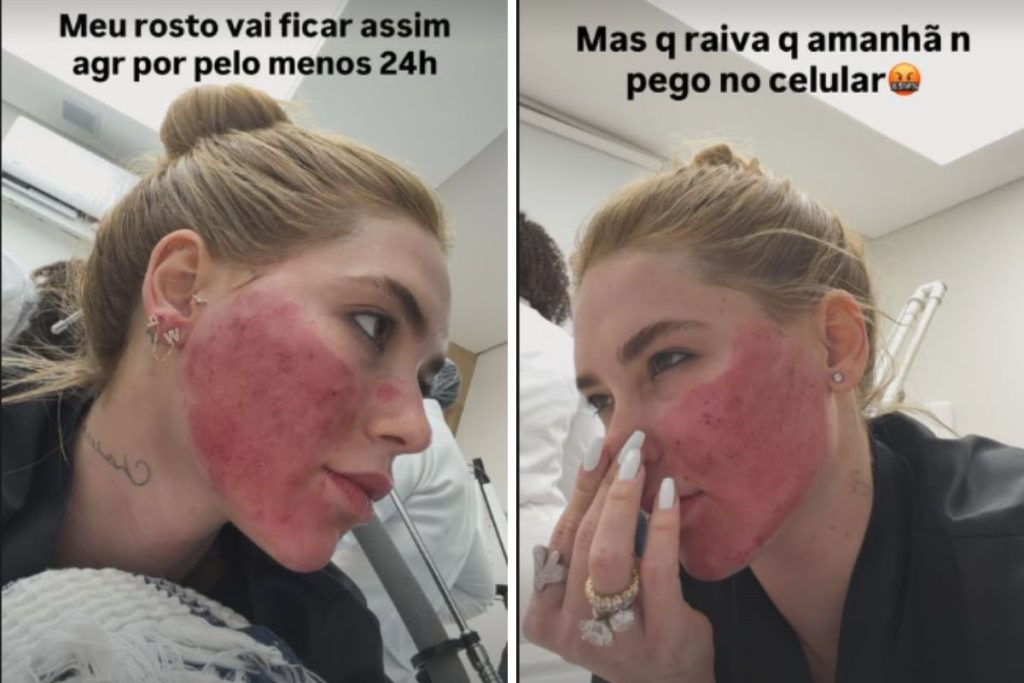 Virginia Fonseca mostra rosto vermelho após tratamento – OFuxico