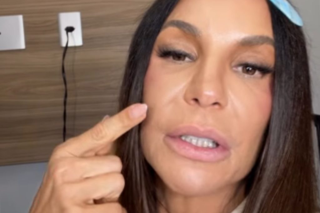 Ivete Sangalo revela condição no rosto: ‘Presilhinha de titânio’ – OFuxico